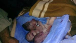 5 maggio 2013 edleb dir asharqi Nahed Alkans i suoi gemelli embrioni di 7 mesi e sua sorella